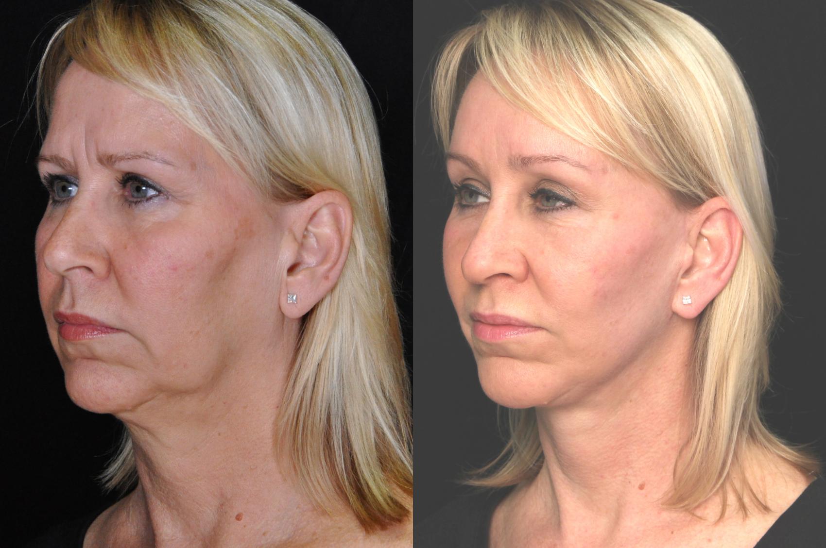 Before & After Facelift Case 533 View #1 View in Panama City & Pensacola, Florida