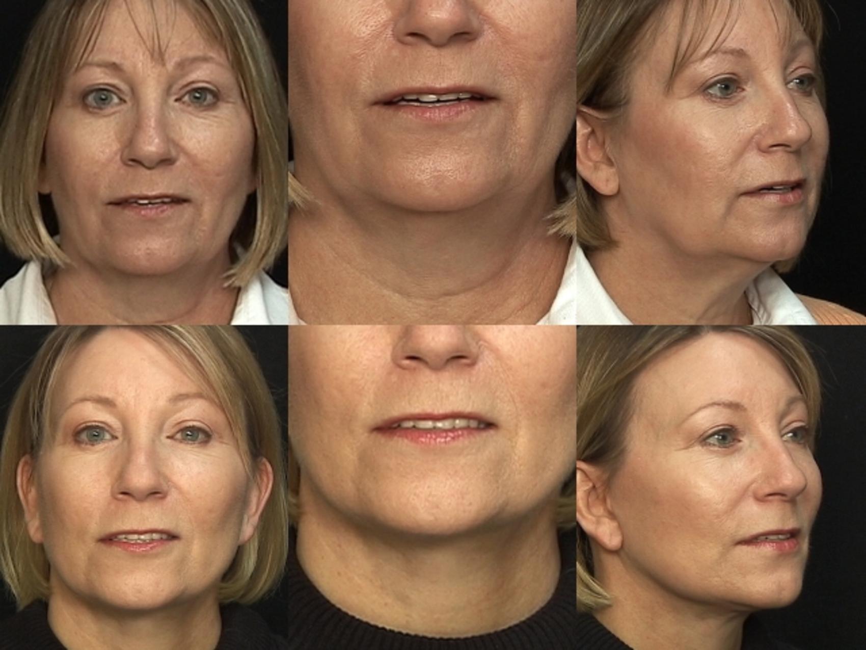 Before & After Facelift Case 55 View #2 View in Destin & Pensacola, Florida