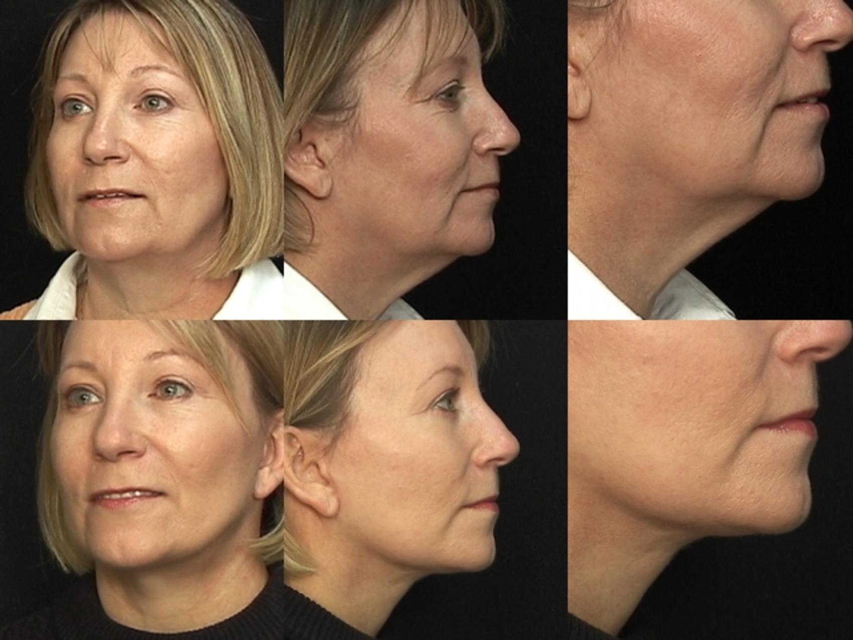 Before & After Facelift Case 55 View #3 View in Destin & Pensacola, Florida