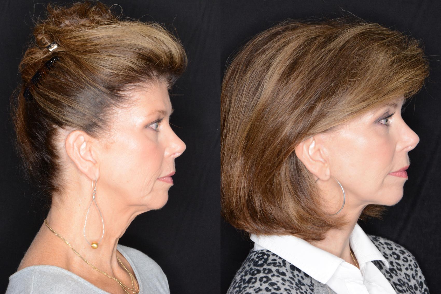 Before & After Facelift Case 560 View #1 View in Panama City & Pensacola, Florida