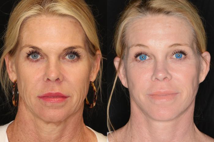 Before & After Facelift Case 590 View #1 View in Panama City & Pensacola, Florida