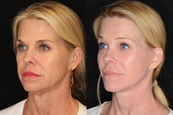 Before & After Facelift Case 591 View #1 View in Panama City & Pensacola, Florida
