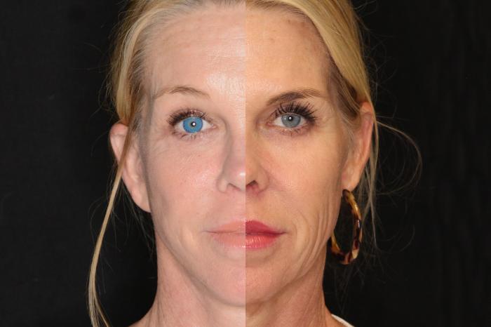 Before & After Facelift Case 592 View #1 View in Panama City & Pensacola, Florida