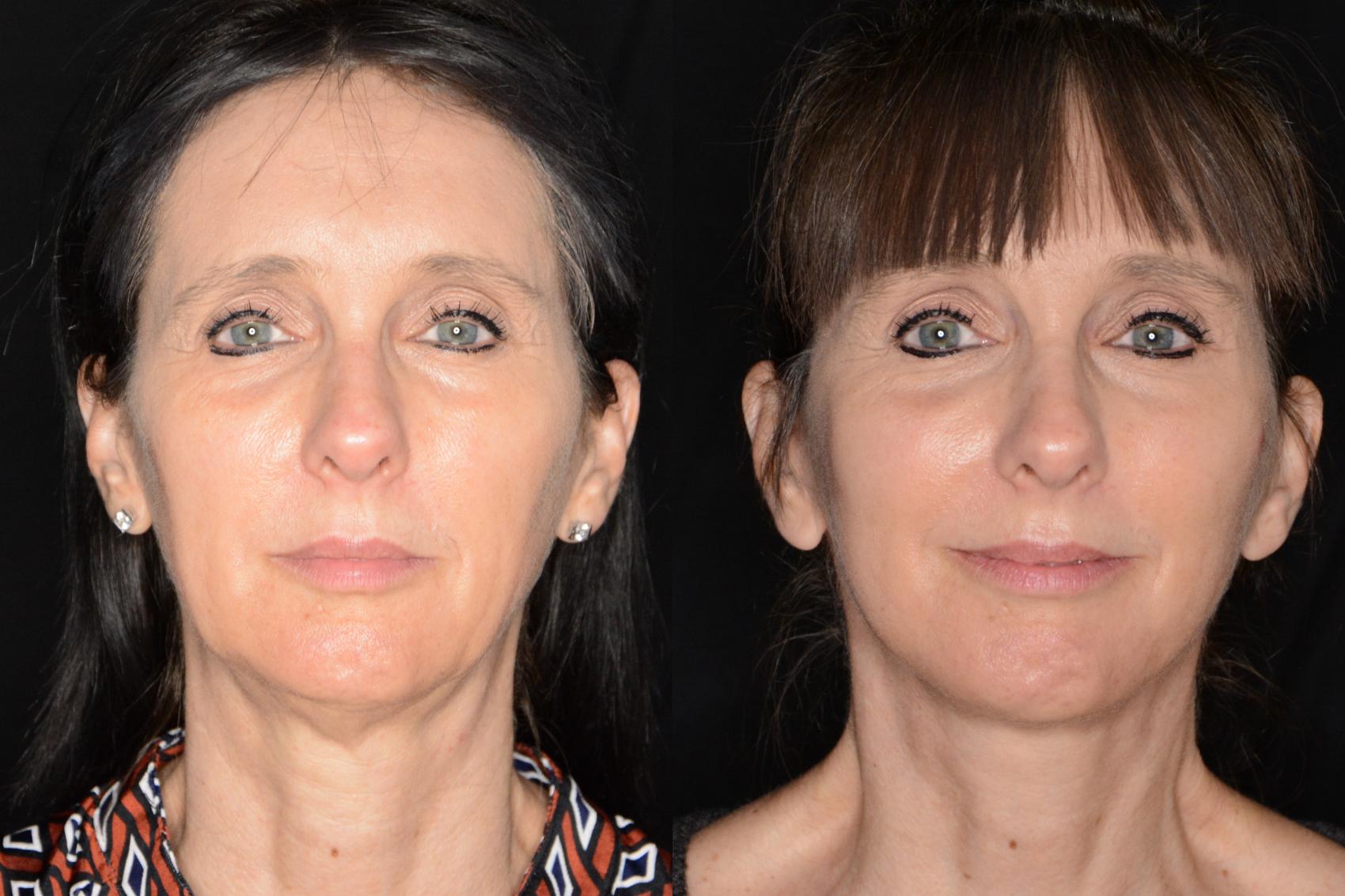 Before & After Facelift Case 593 View #1 View in Panama City & Pensacola, Florida