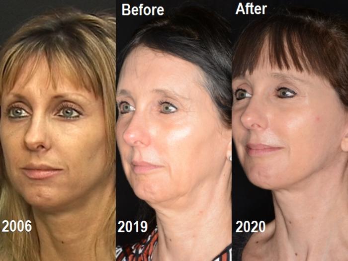 Before & After Facelift Case 595 View #1 View in Panama City & Pensacola, Florida