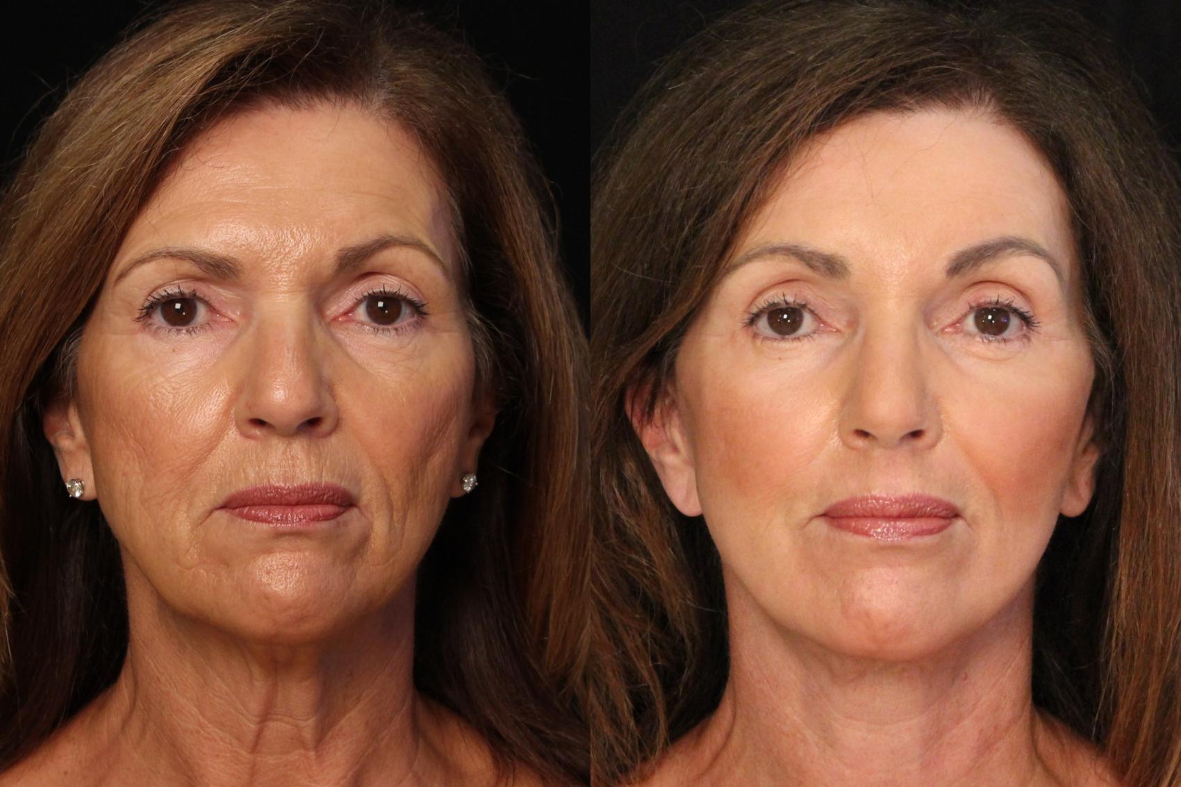 Before & After Facelift Case 599 View #1 View in Panama City & Pensacola, Florida