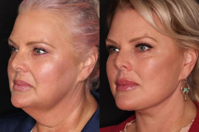 Before & After Eyelid Surgery Case 614 Left Oblique View in Destin, FL & Pensacola, FL