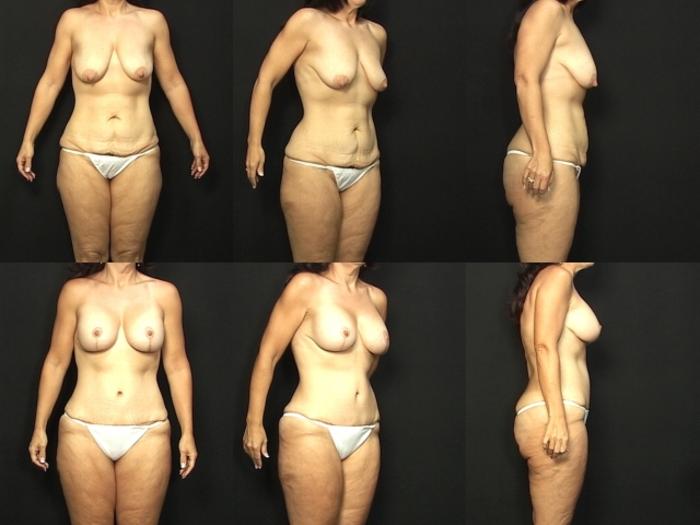 Before & After Liposuction Case 21 View #1 View in Panama City & Pensacola, Florida