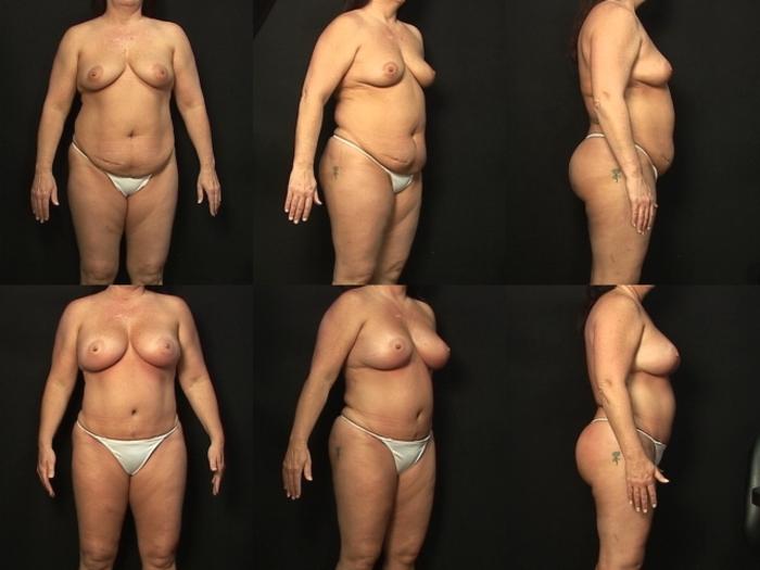 Before & After Liposuction Case 278 View #1 View in Panama City & Pensacola, Florida
