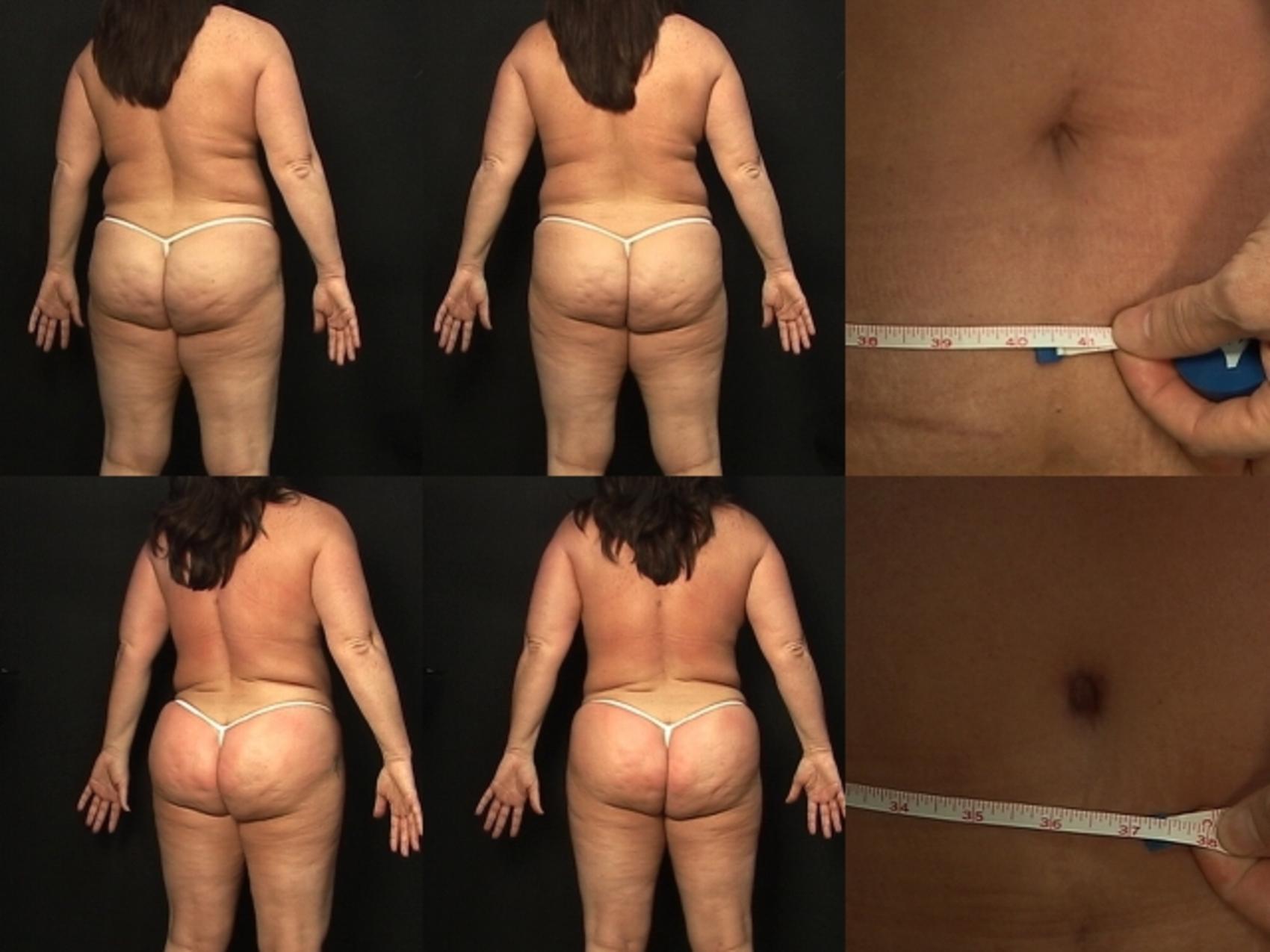 Before & After Liposuction Case 278 View #2 View in Destin & Pensacola, Florida