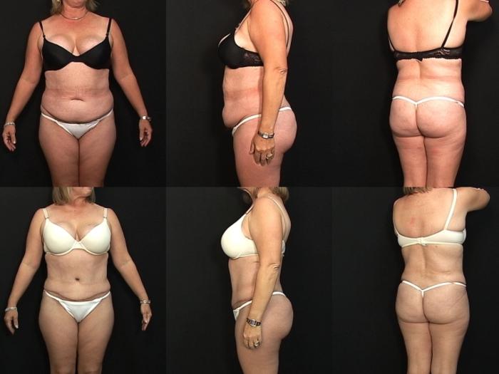 Before & After Liposuction Case 29 View #1 View in Panama City & Pensacola, Florida