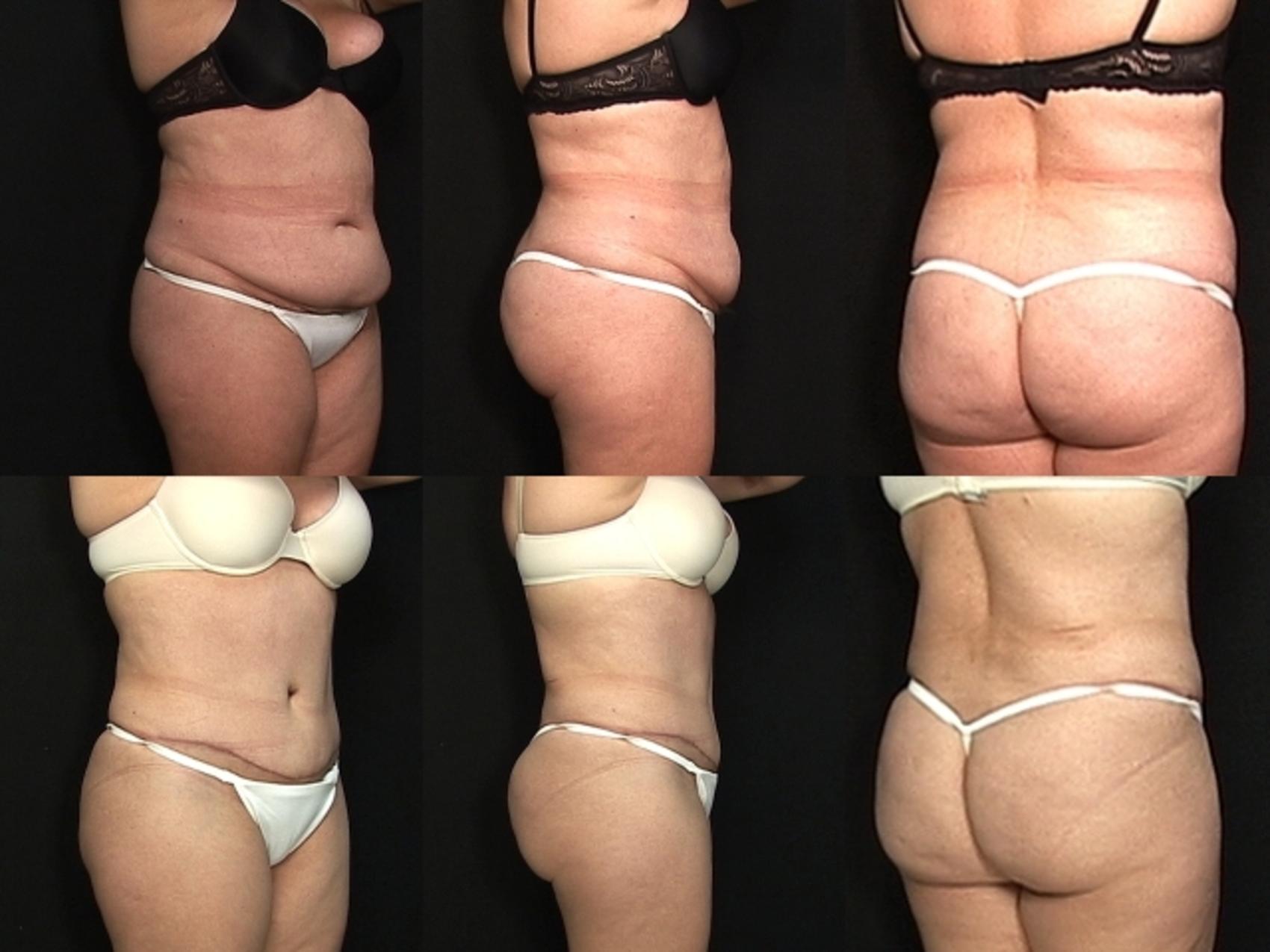 Before & After Liposuction Case 29 View #2 View in Destin & Pensacola, Florida