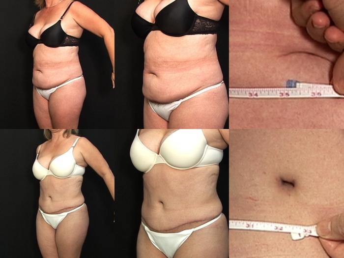 Before & After Liposuction Case 29 View #3 View in Panama City & Pensacola, Florida