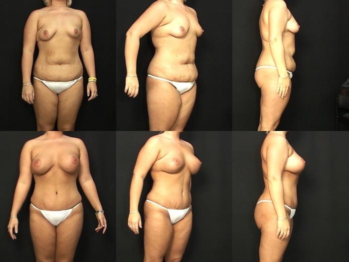 Before & After Liposuction Case 30 View #1 View in Panama City & Pensacola, Florida