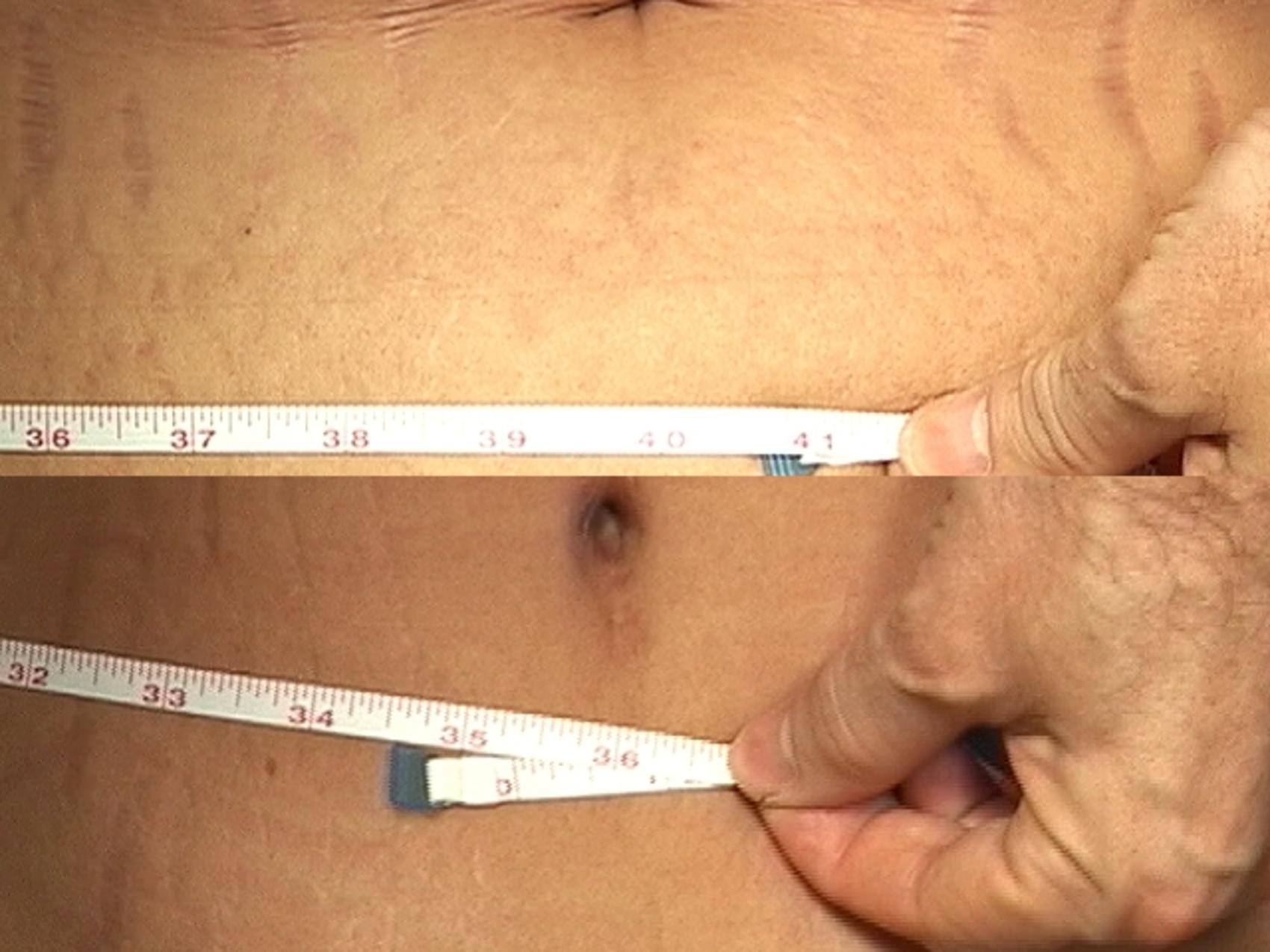 Before & After Liposuction Case 30 View #2 View in Destin & Pensacola, Florida