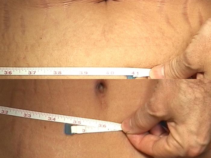 Before & After Liposuction Case 30 View #2 View in Panama City & Pensacola, Florida