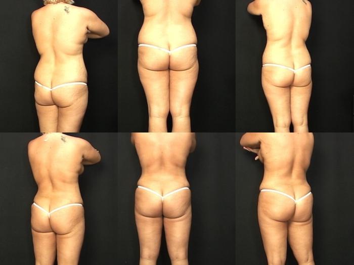 Before & After Liposuction Case 30 View #3 View in Panama City & Pensacola, Florida