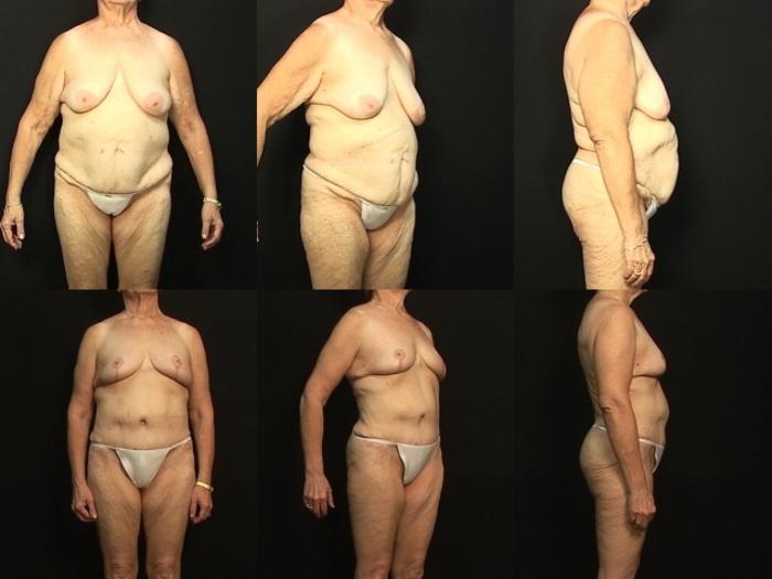 Before & After Liposuction Case 33 View #1 View in Panama City & Pensacola, Florida