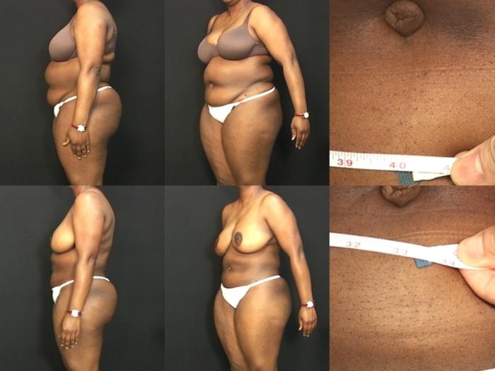 Before & After Liposuction Case 366 View #1 View in Panama City & Pensacola, Florida