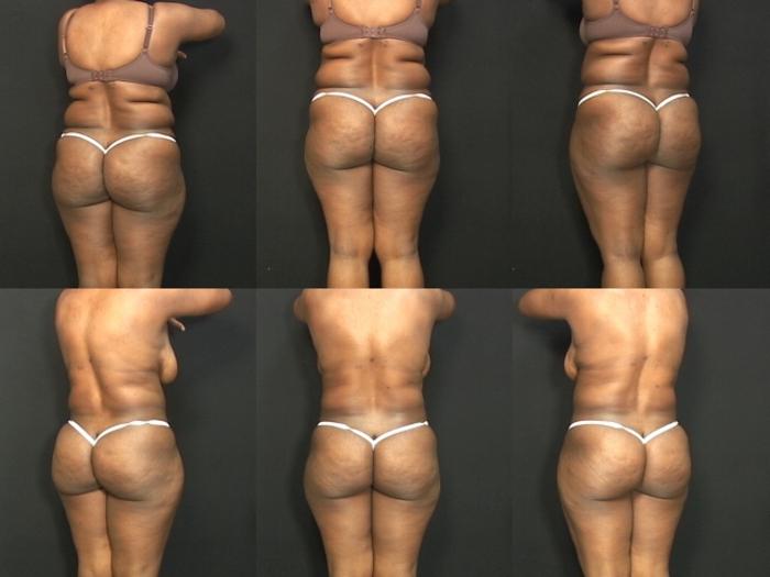 Before & After Liposuction Case 366 View #2 View in Panama City & Pensacola, Florida