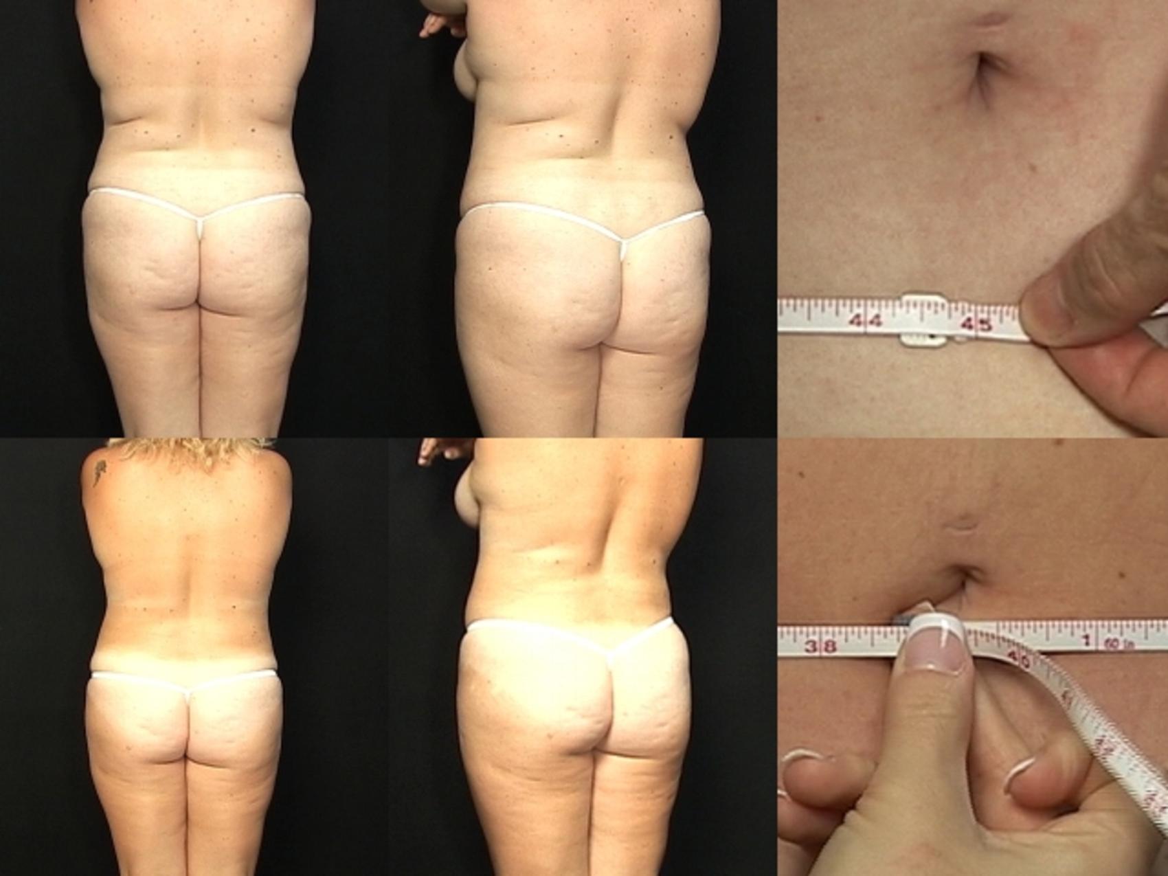 Before & After Liposuction Case 367 View #2 View in Destin & Pensacola, Florida