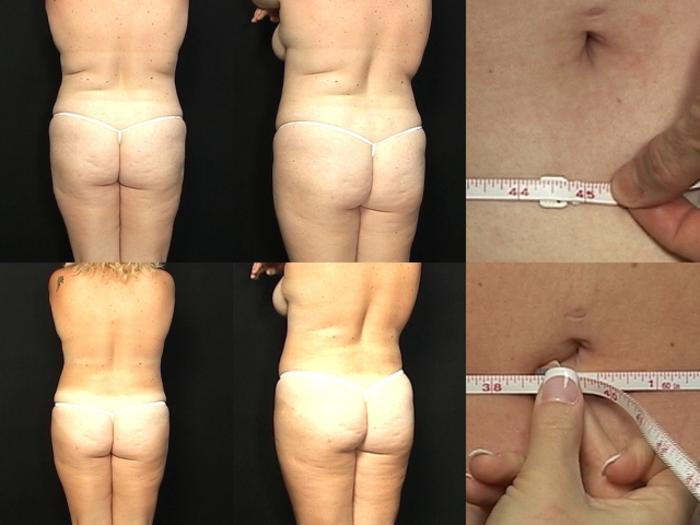 Before & After Liposuction Case 367 View #2 View in Panama City & Pensacola, Florida