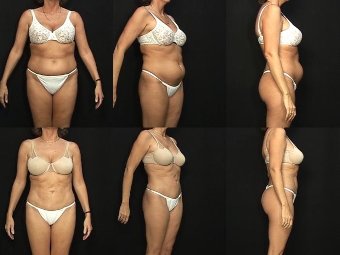 Before & After Liposuction Case 368 View #1 View in Panama City & Pensacola, Florida