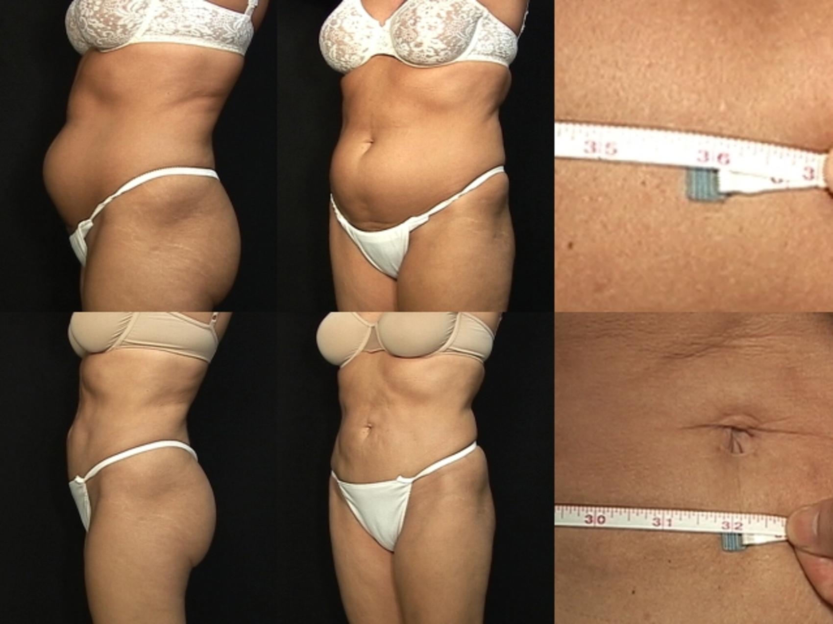 Before & After Liposuction Case 368 View #2 View in Destin & Pensacola, Florida