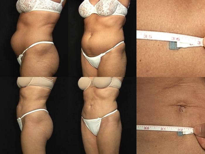 Before & After Liposuction Case 368 View #2 View in Panama City & Pensacola, Florida
