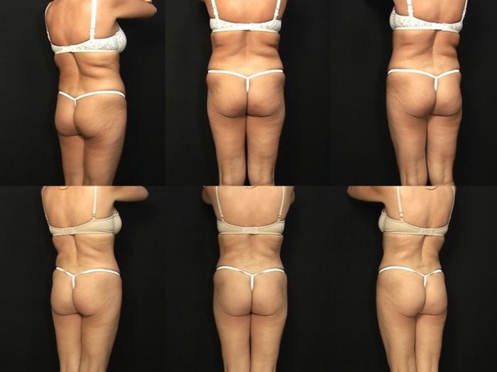 Before & After Liposuction Case 368 View #3 View in Panama City & Pensacola, Florida