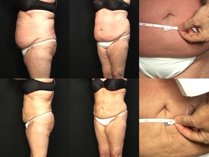 Before & After Liposuction Case 370 View #1 View in Panama City & Pensacola, Florida