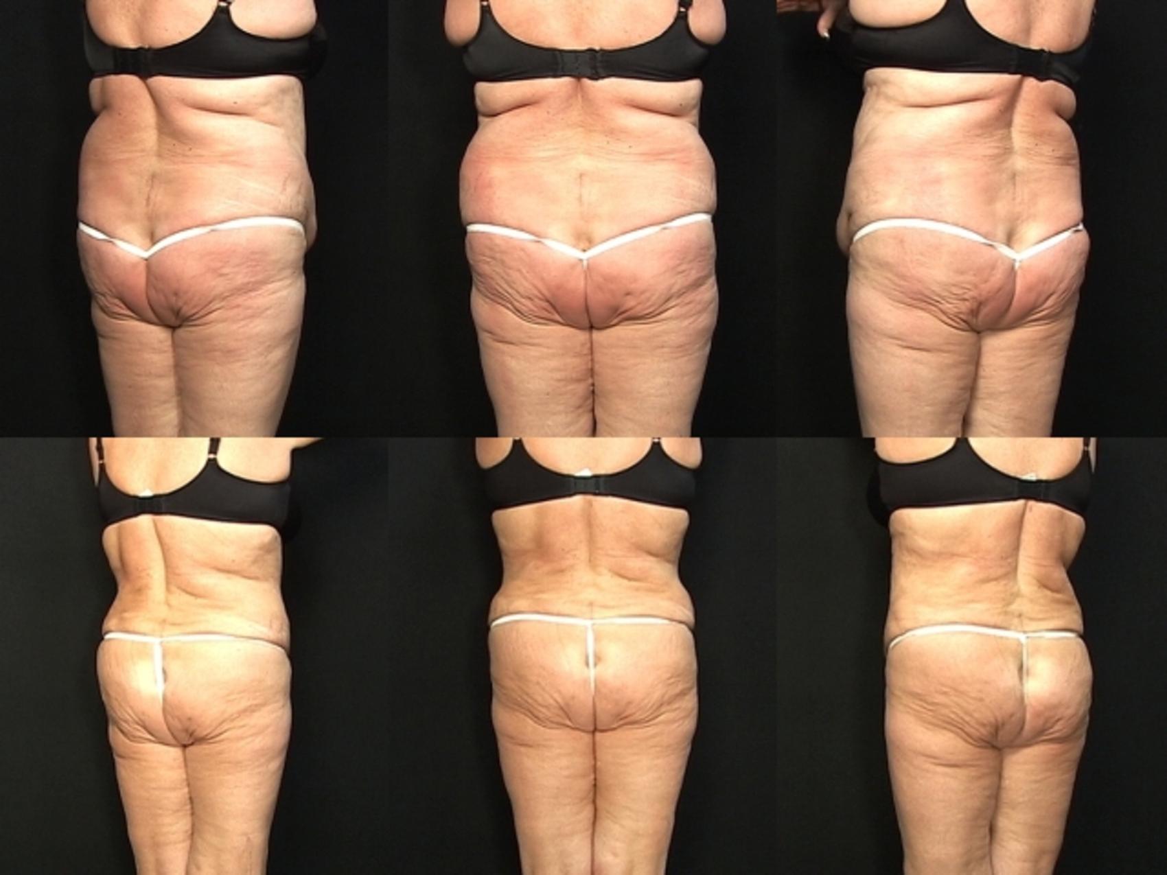 Before & After Liposuction Case 370 View #2 View in Destin & Pensacola, Florida