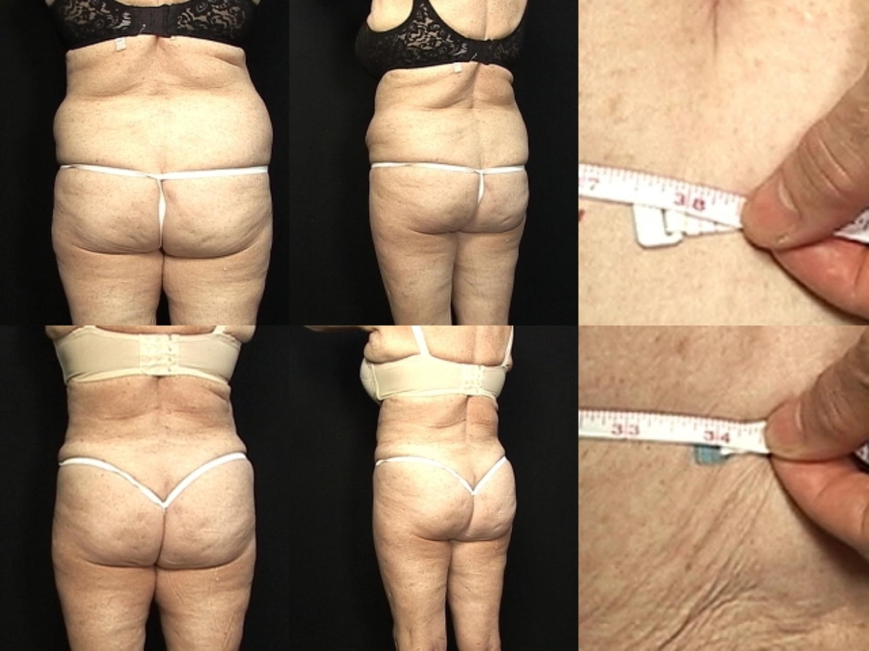 Before & After Liposuction Case 371 View #1 View in Panama City & Pensacola, Florida