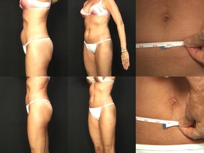 Before & After Liposuction Case 372 View #1 View in Panama City & Pensacola, Florida