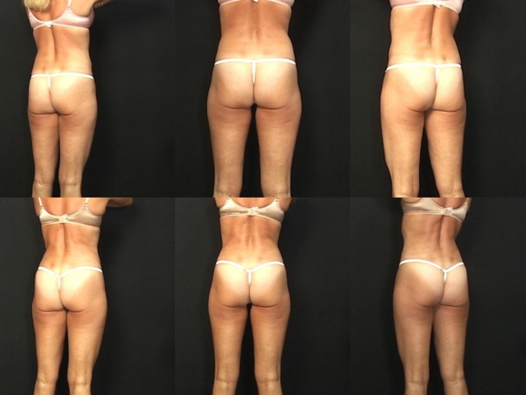 Before & After Liposuction Case 372 View #2 View in Destin & Pensacola, Florida