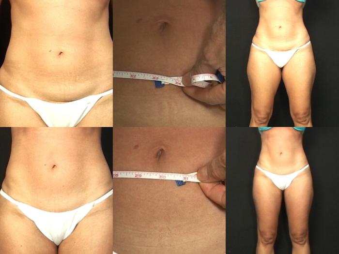Before & After Liposuction Case 382 View #1 View in Panama City & Pensacola, Florida