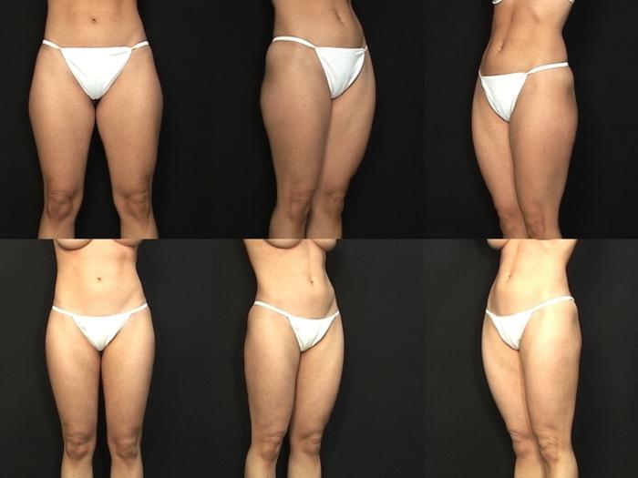 Before & After Liposuction Case 429 View #1 View in Panama City & Pensacola, Florida