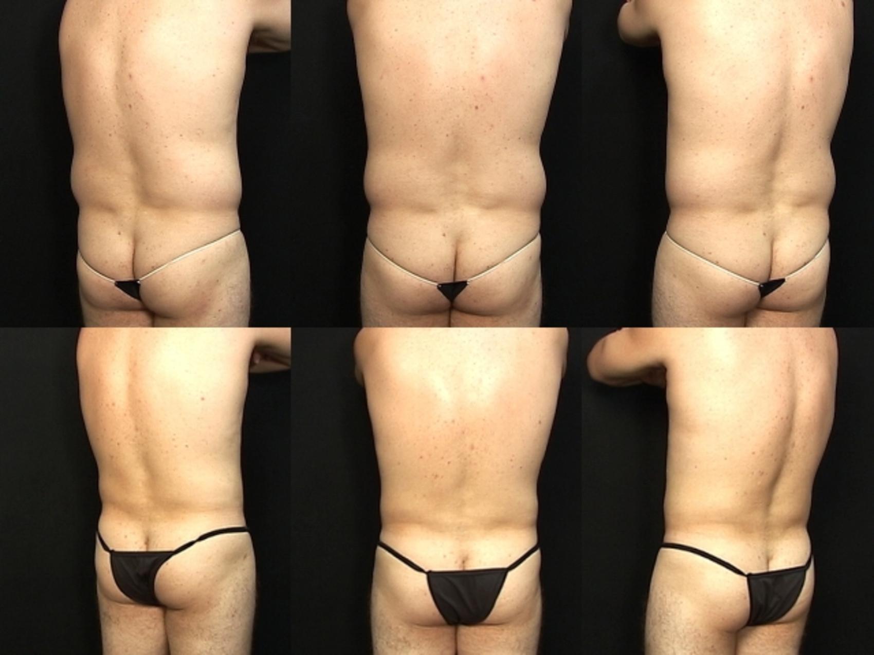 Before & After Liposuction Case 430 View #2 View in Destin & Pensacola, Florida