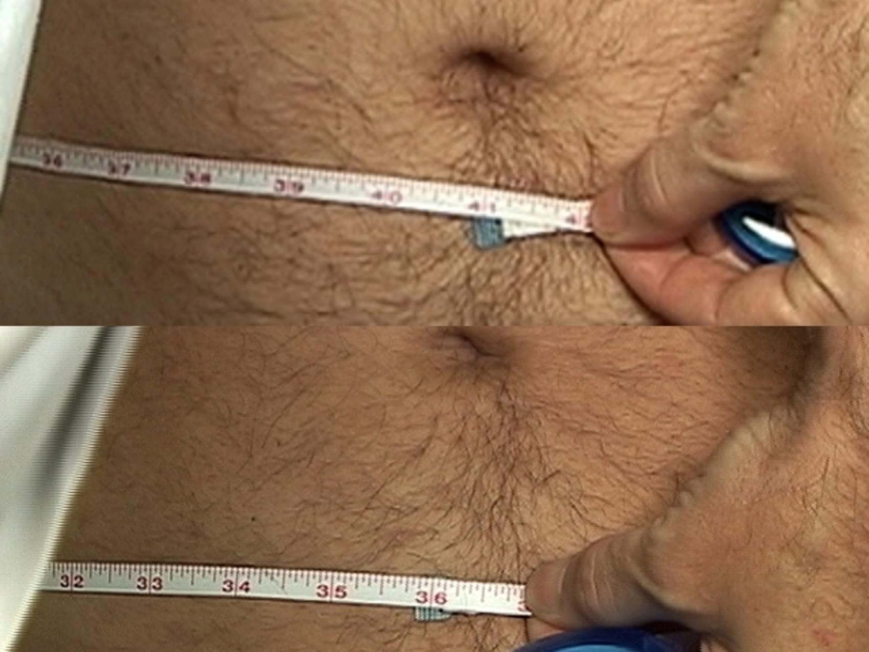 Before & After Liposuction Case 430 View #3 View in Destin & Pensacola, Florida