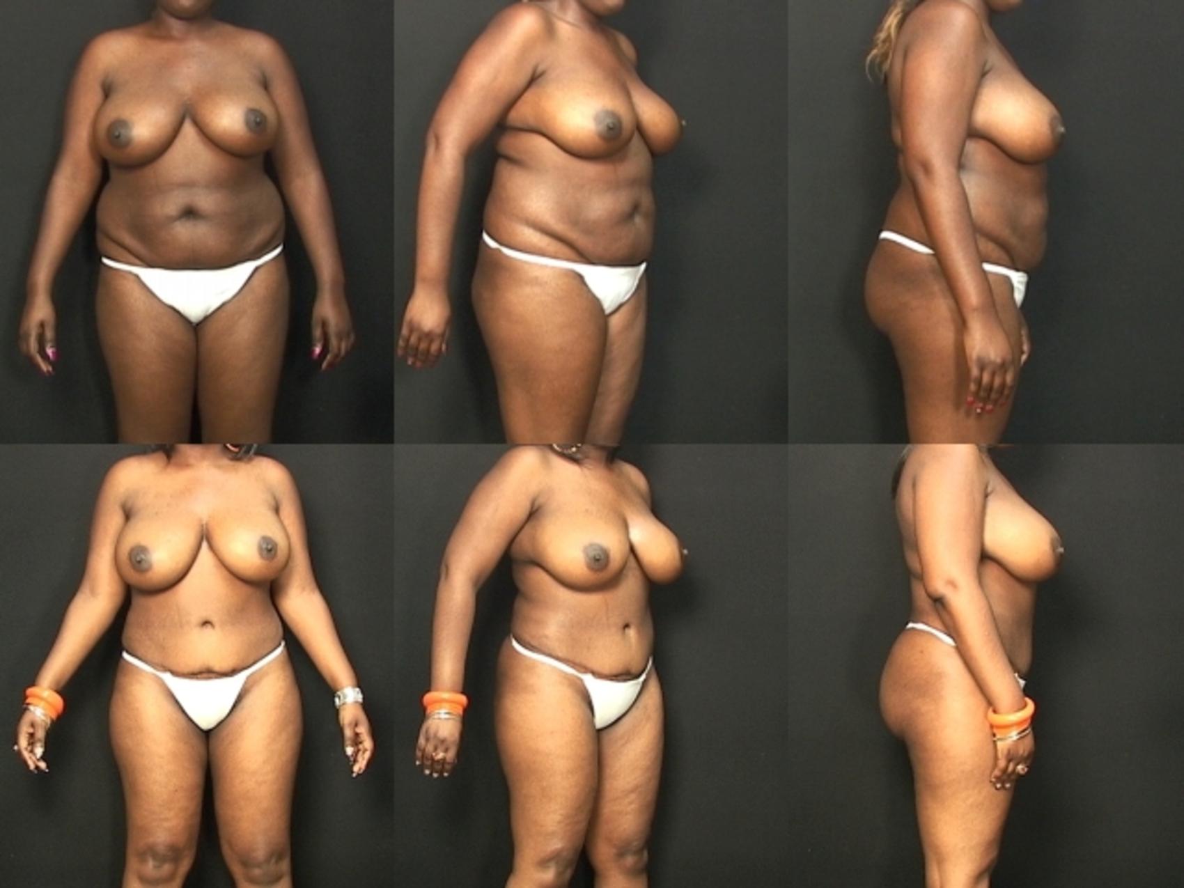Before & After Liposuction Case 431 View #1 View in Panama City & Pensacola, Florida