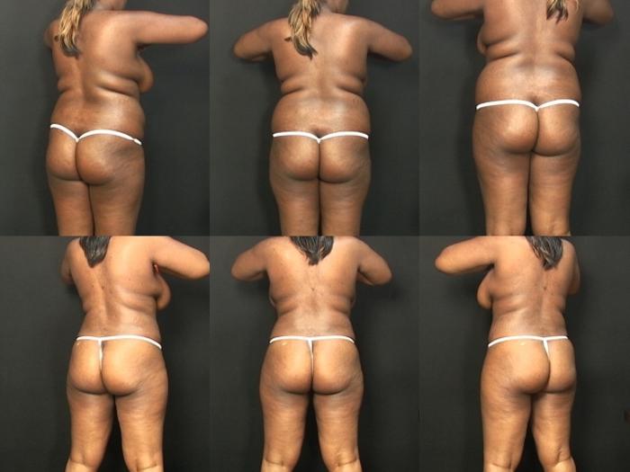 Before & After Liposuction Case 431 View #2 View in Panama City & Pensacola, Florida
