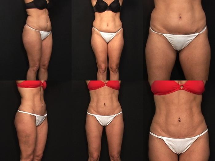 Before & After Liposuction Case 432 View #1 View in Panama City & Pensacola, Florida