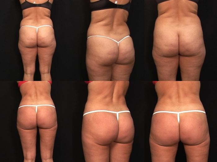 Before & After Liposuction Case 432 View #2 View in Panama City & Pensacola, Florida