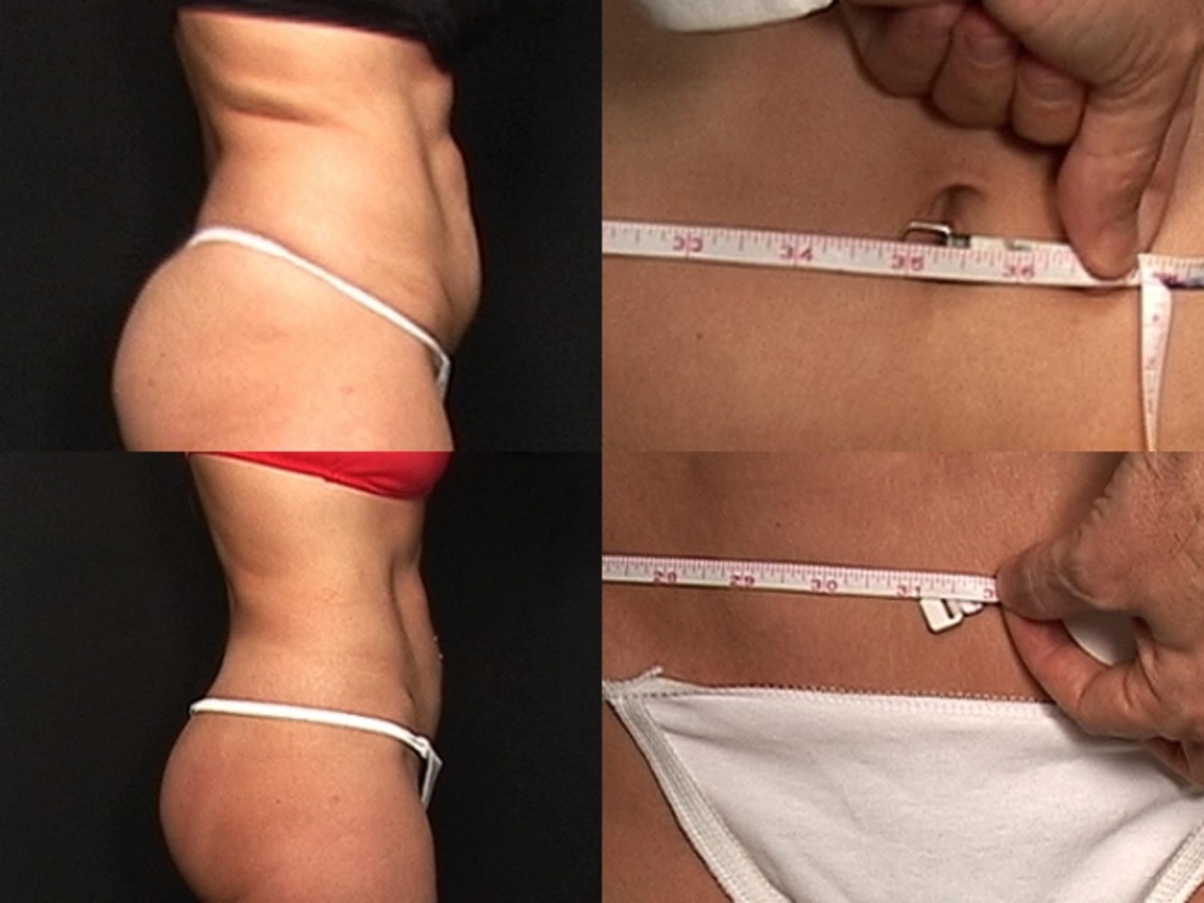 Before & After Liposuction Case 432 View #3 View in Destin & Pensacola, Florida
