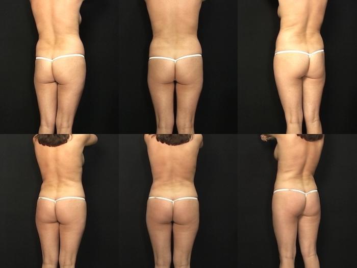 Before & After Liposuction Case 433 View #2 View in Panama City & Pensacola, Florida
