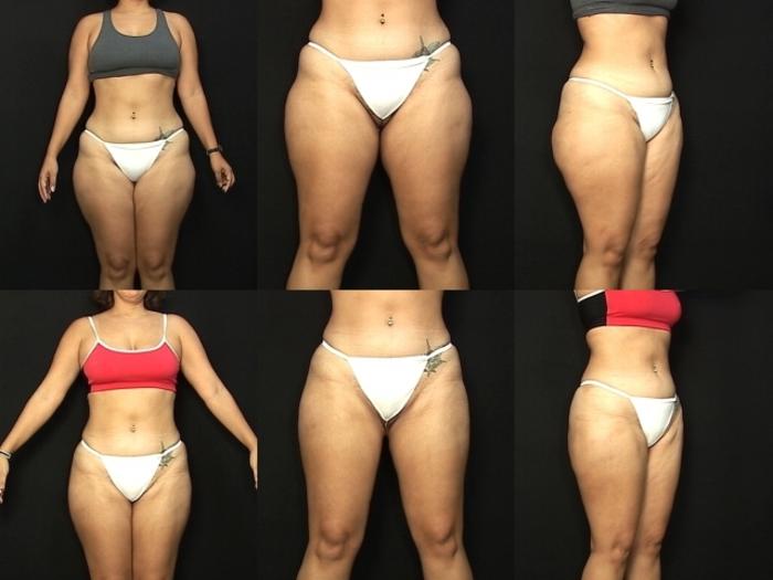 Before & After Liposuction Case 434 View #1 View in Panama City & Pensacola, Florida