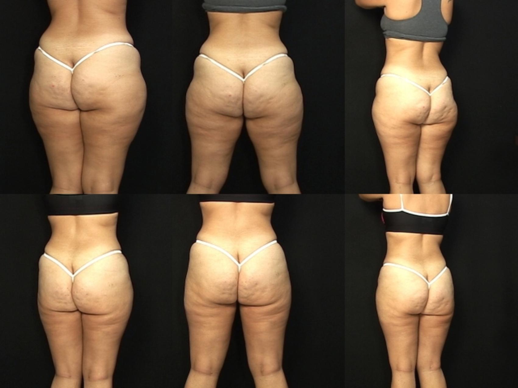 Before & After Liposuction Case 434 View #2 View in Destin & Pensacola, Florida