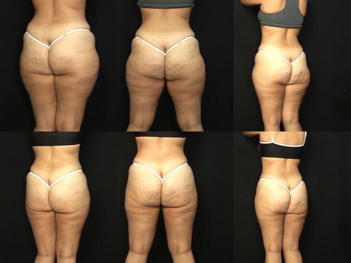 Before & After Liposuction Case 434 View #2 View in Panama City & Pensacola, Florida