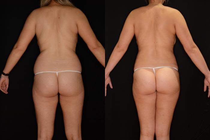 Before & After Liposuction Case 527 View #1 View in Panama City & Pensacola, Florida