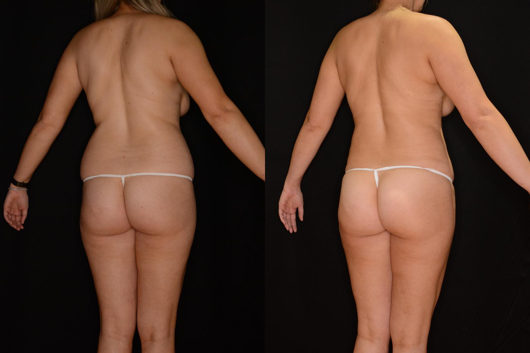 Before & After Liposuction Case 527 View #2 View in Destin & Pensacola, Florida